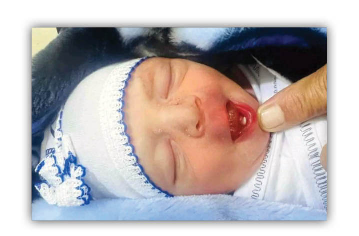 نوزادی با یک دندان به دنیا آمد